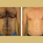 Electrolysis Laser hair removal in dubai