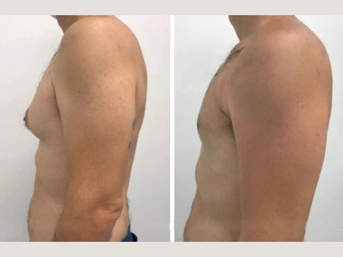 gynecomastia in dubai