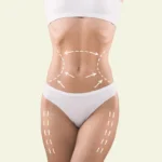 fat transfer in dubai