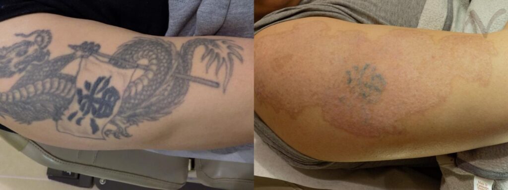 Tattoo Removal in Brentwood