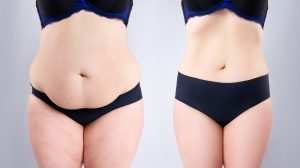 Abdominoplasty Dubai: Transform Your Core with Expert Care