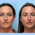 Best Plastic Surgeon in Dubai for Thread Lift to Achieve a Fresh, Natural Look