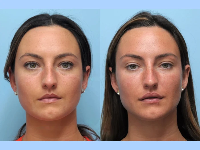 Best Plastic Surgeon in Dubai for Thread Lift to Achieve a Fresh, Natural Look